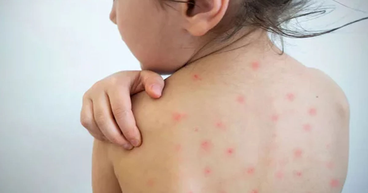 দৈনিক পূর্বকোণ - চট্টগ্রামের দৈনিক হাম ও হামের উপসর্গ নিয়ে আরও ৫ শিশুর মৃত্যু