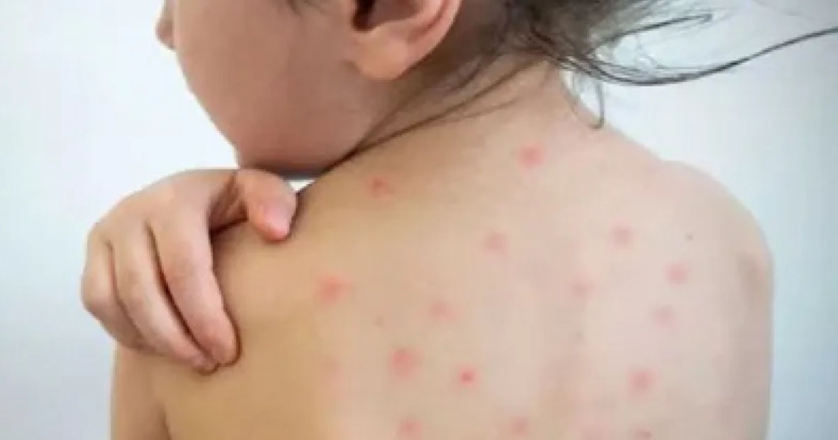 ঈদের দিনে হাম কেড়ে নিলো আরও ৫ প্রাণ