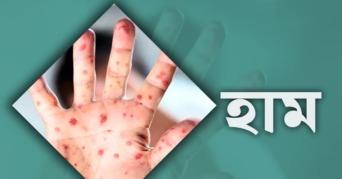 দৈনিক পূর্বকোণ - চট্টগ্রামের দৈনিক হাম উপসর্গে আরও ৫ শিশুর মৃত্যু