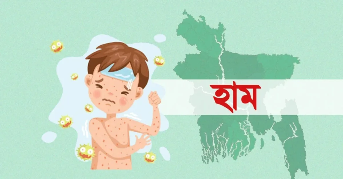 দৈনিক পূর্বকোণ - চট্টগ্রামের দৈনিক হামের উপসর্গে আরও ৫ শিশুর মৃত্যু