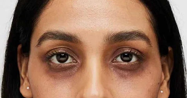 দৈনিক পূর্বকোণ - চট্টগ্রামের দৈনিক চোখের নিচের কালো দাগ কমাতে যে অভ্যাস বদলাতে হবে