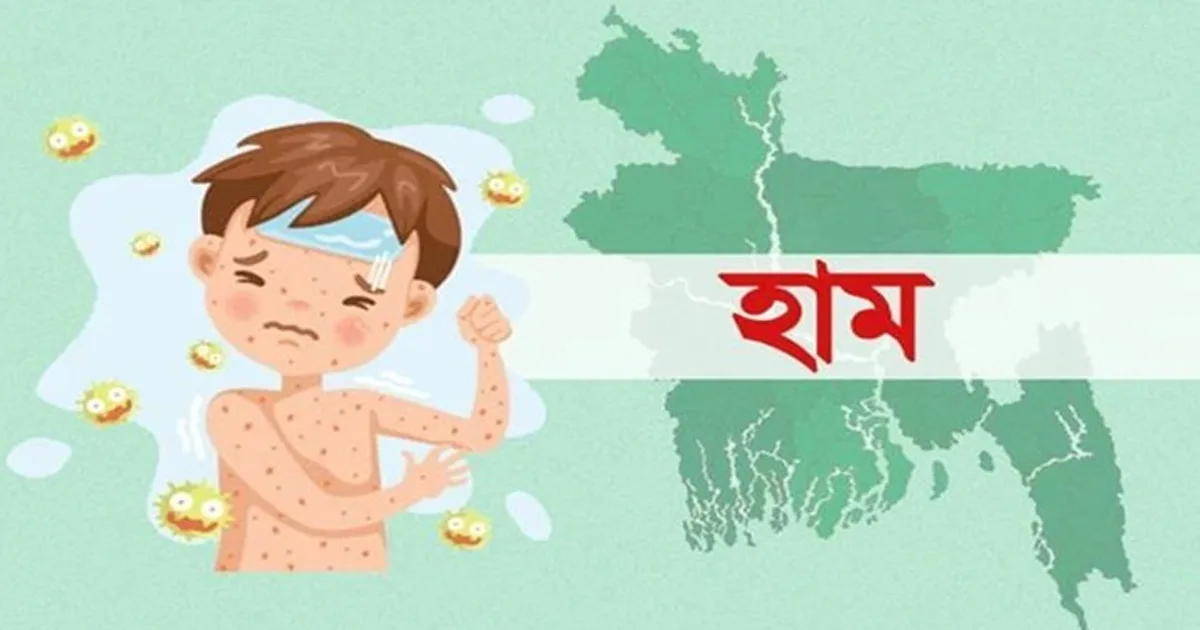 দৈনিক পূর্বকোণ - চট্টগ্রামের দৈনিক ২৪ ঘণ্টায় হাম উপসর্গে ২ শিশুর মৃত্যু, আক্রান্ত ১০১৯