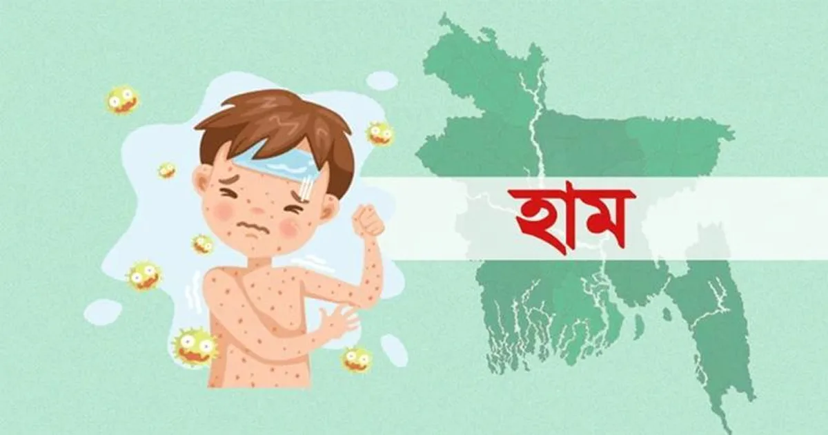 দৈনিক পূর্বকোণ - চট্টগ্রামের দৈনিক হাম উপসর্গে ৫ জনের মৃত্যু