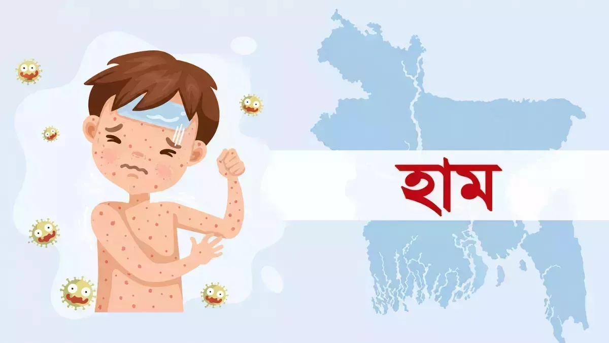 দৈনিক পূর্বকোণ - চট্টগ্রামের দৈনিক ২৪ ঘণ্টায় হাম উপসর্গে তিনজনের মৃত্যু, নতুন আক্রান্ত ১৩৪৯